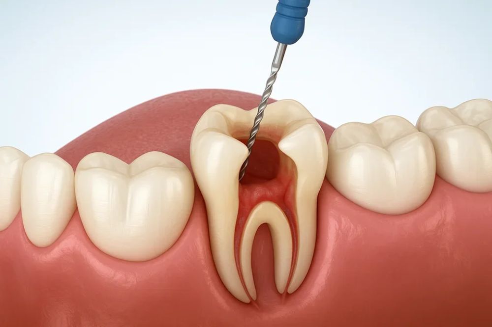 how do i know if i need a root canal